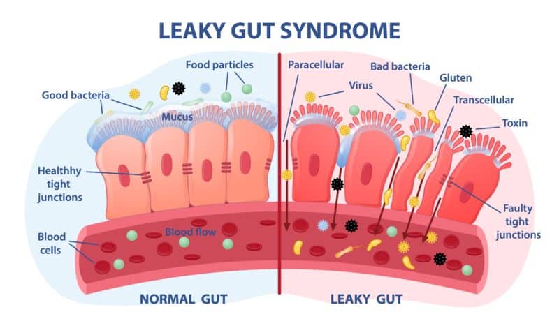 Leaky Gut Syndrome infographic showing the difference between a normal gut and a leaky gut.